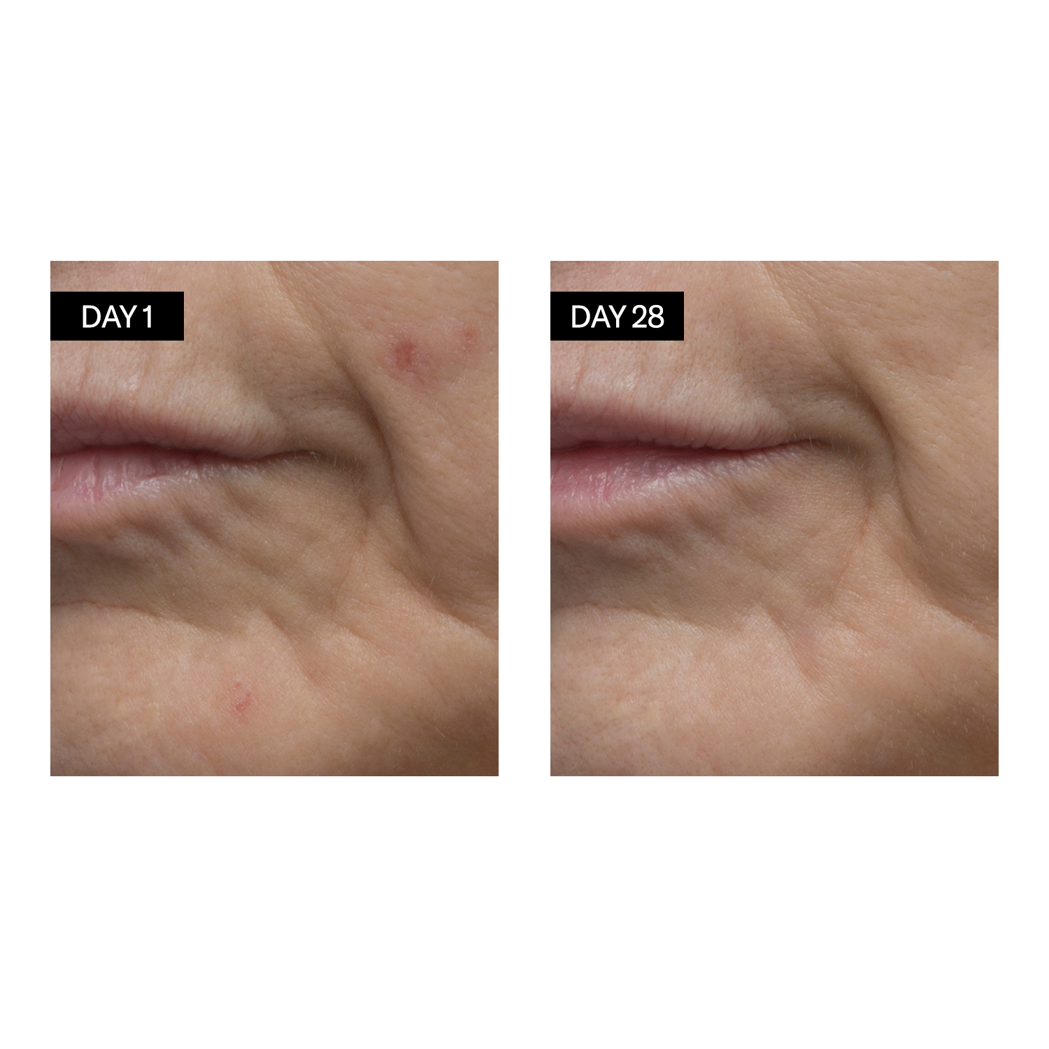 Avant /après : Sérum Rénovant - Rétinol + Acide Hyaluronique - Odacité